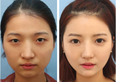 双眼皮手术恢复过程