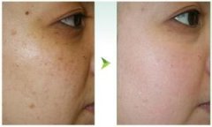 彩光嫩肤的价格咨询