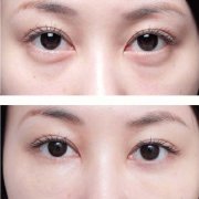眼袋怎么消除