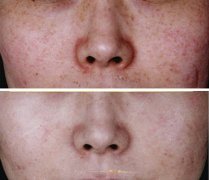 激光美容一般多少钱