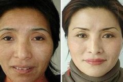 注射去皱多少钱