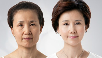 注射去皱多少钱