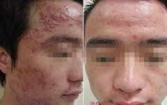 去除痘痘有妙招