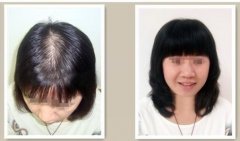 脱发严重怎么办