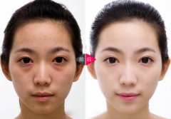 黑眼圈的形成原因