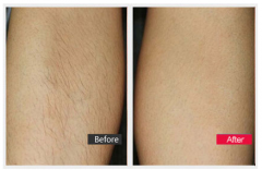 冰点脱毛有副作用吗