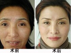 额头皱纹怎么去除