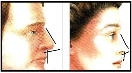 男人隆鼻选择哪种好？