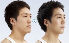 男人隆鼻选择哪种好？