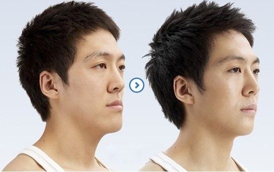 男人隆鼻选择哪种好？