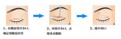 哪家医院割双眼皮好