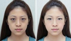 怎么快速去掉黑眼圈