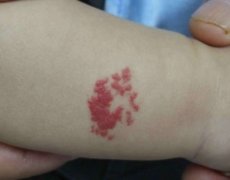 血管瘤的调节方法