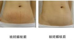 妊娠纹能消除吗