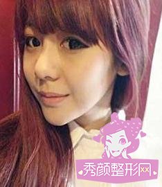 玻尿酸隆鼻+垫下巴真人案例