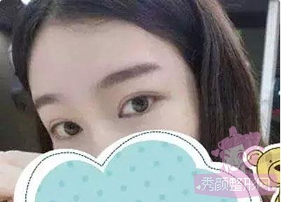 【隆鼻手术】和大家分享我的隆鼻经验