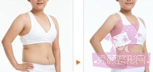 做了腰腹吸脂，来感受下我的小蛮腰~