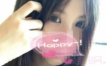 【案例分享】割了双眼皮，天天好心情