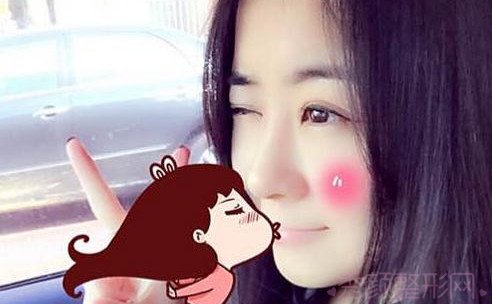 【日记】我的割双眼皮8mm大平行恢复过程图