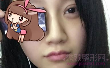 【西安双眼皮】开双眼皮+开眼角5个月后果图