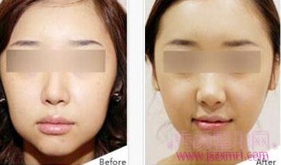 上海仁爱刘庆阳做下颌骨整形怎么样?