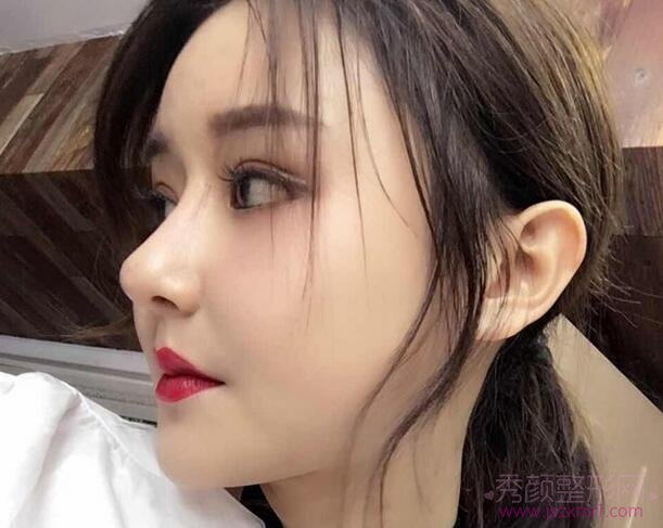 一直心心念的脂肪填充和硅胶隆鼻手术终于做了