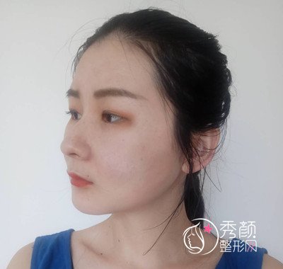 上海九院徐梁磨颧骨和下颌角整形案例。