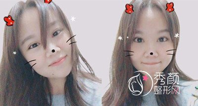 <b>吴海龙做双眼皮怎么样,案例图。</b>