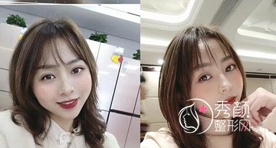 广州紫馨李政佑双眼皮修复技术怎样,案例分享。