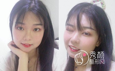 天津美莱下颌角磨骨整形案例分享。