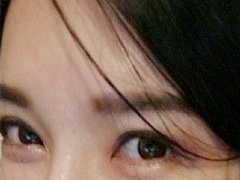 做了自体筋膜丰卧蚕满三个月了，写一下功课吧