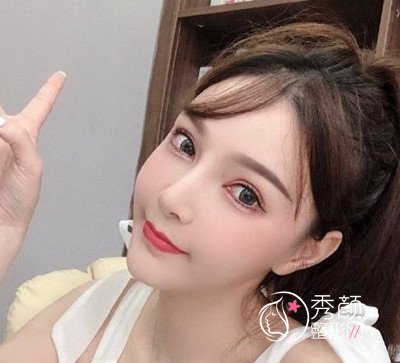 上海美联臣假体隆鼻和垫下巴及下颌角整形案例全过程分享。
