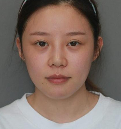 北京米扬丽格巫文云膨体+鼻中隔鼻修复案例。