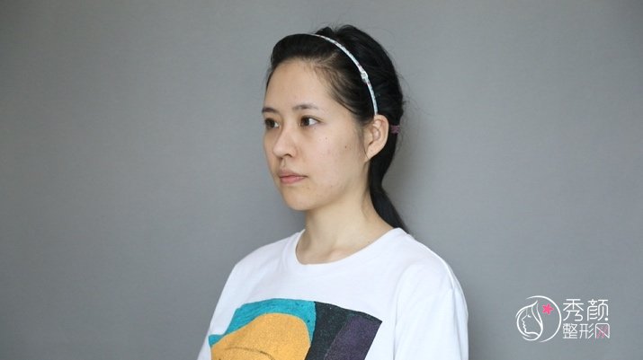  【隆鼻案例】北京米扬丽格医疗美容医生夏正义隆鼻果怎么样？