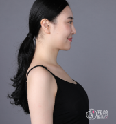 <b>南京华美美容医生沈正宇假体隆胸案例分享！</b>