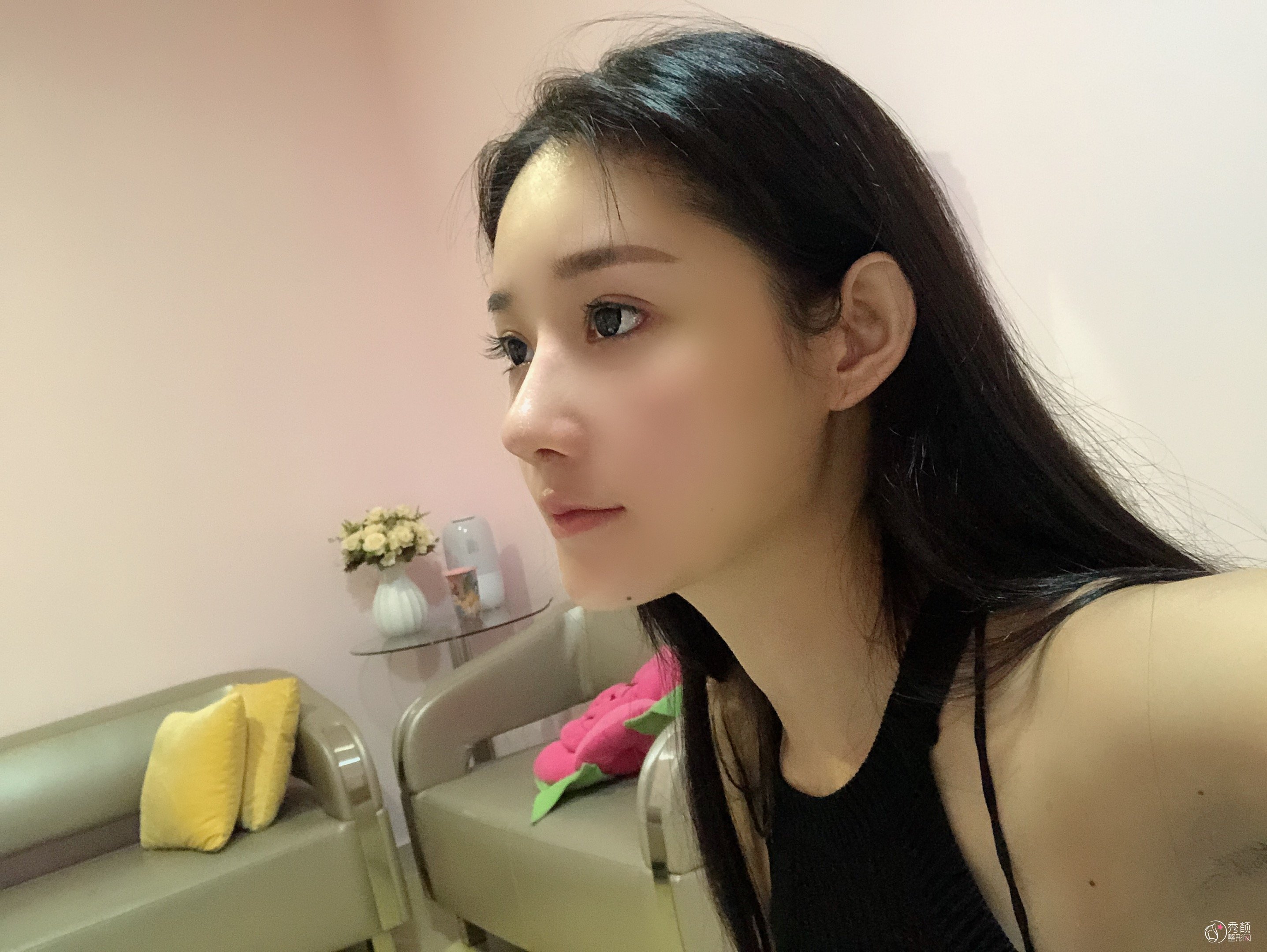 广州艺美医疗美容医生李闯鼻部多项手术案例分享！