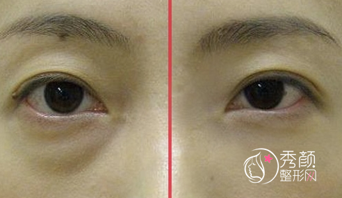 <b>激光祛眼袋果怎么样?</b>