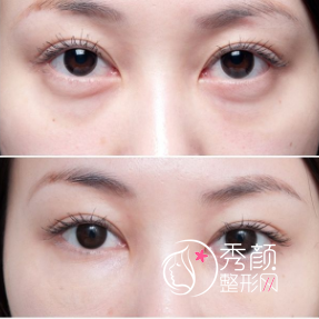 <b>如何避免去眼袋手术并发症?</b>