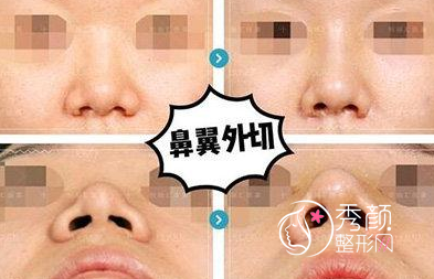 <b>河南整形鼻翼缩小的价格</b>