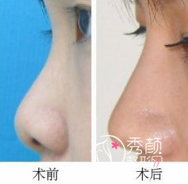 <b>鼻子注射过玻尿酸,现在想做假体,多久能做?</b>