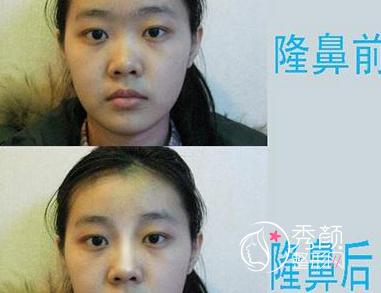 <b>影响小清新隆鼻价格的关键因素</b>