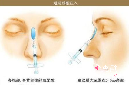 <b>深圳美莱玻尿酸注射隆鼻靠谱吗?</b>