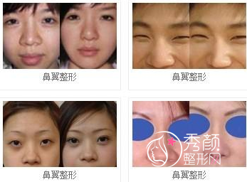 <b>深圳做鼻翼整形的费用需要多少</b>