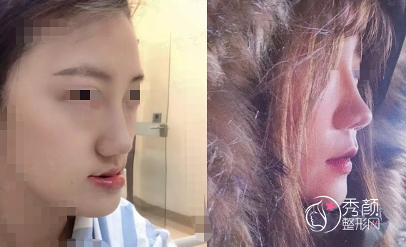 严重的反颌，武汉吴中兴做了正颌+切下颌角，现在也是个美人胚子了