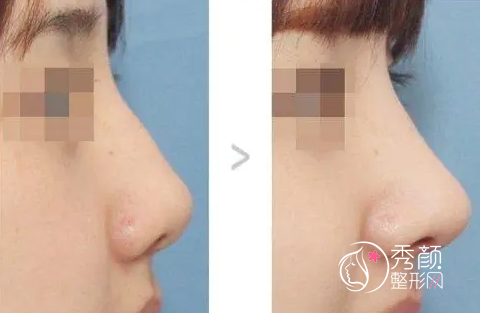 广州隆鼻医生排名前十|金孝宪、邓正军、张明兴、沈绍勇、邓正军等上榜