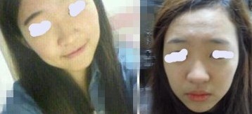 我做了硅胶+耳软骨，翘鼻梦终于了