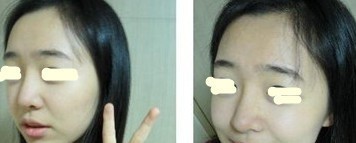 我做了硅胶+耳软骨，翘鼻梦终于了