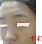 我做了硅胶+耳软骨，翘鼻梦终于了