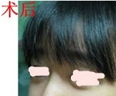 我做了硅胶+耳软骨，翘鼻梦终于了