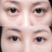 <b>去眼袋术前术后对比图</b>